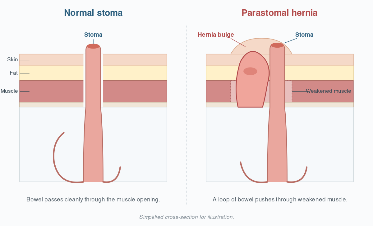 Cross-section diagram comparing a normal stoma to a parastomal hernia, showing bowel tissue pushing through the weakened abdominal wall alongside the stoma